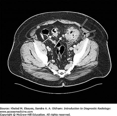 Accessmedicines Image Of The Week Diverticulitis On Ct Abdomen