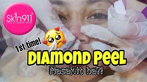 What Is Diamond Peel My First Diamond Peel Experience Featuring Skin