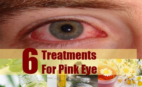 6 Treatments For Pink Eye Natural Home Remedies And Supplements