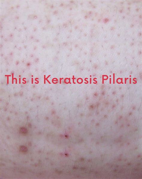 Dermatologist Formulated Body Scrub Exfoliant For Keratosis Pilaris And