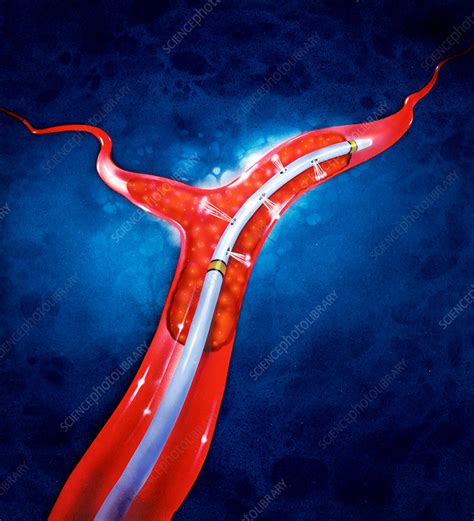 Illustration Of Brain Blood Clot Therapy Stock Image P2600129