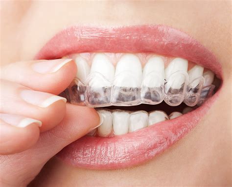 An important aspect of orthodontic treatment using. Ways To Straighten Teeth Without Braces | Straightening ...