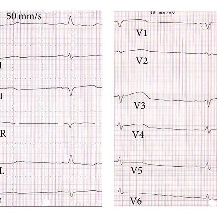 Echocardiogram Shows A Huge Swelling Of The Intraventricular Septal