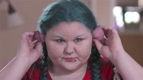 Dr Pimple Popper Treats A Patient With Massive Keloids On Her Ears In