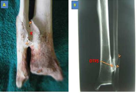Photograph Of The Distal End Of The Posterior Surface Of The Left Tibia