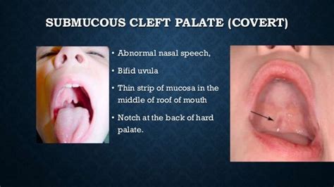Occult Submucous Cleft Palate