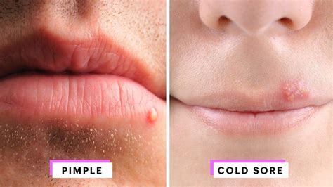 Awesome Cold Sore Symptoms Lip Line And Review In 2020 How To Line