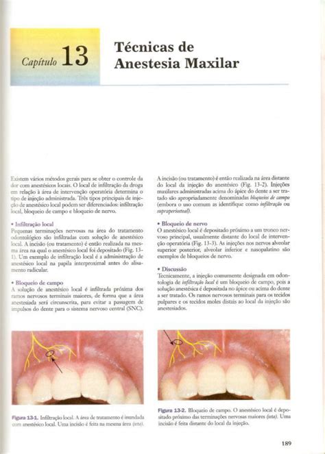 Tecnicas De Anestesia Maxilar Cirurgia Buco Maxilo Facial