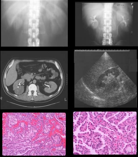 Renal Cell Carcinoma Ultrasound Kidney
