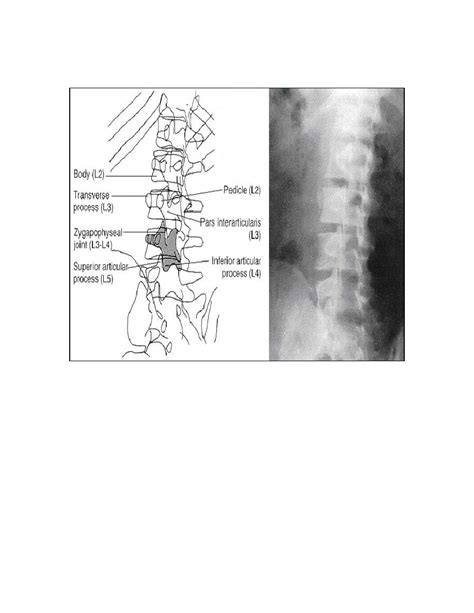 Right Posterior Oblique Or Left Posterior Oblique Lumbar Spine