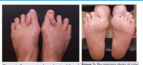 Figure 2 From A Case Report Of Spontaneous Second Toe Varus Deformity