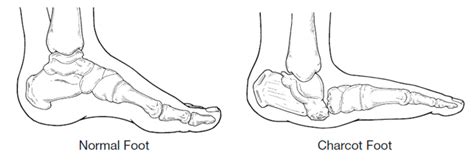 Charcot Foot Foot Podiatrist