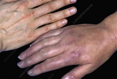 Hand In Systemic Sclerosis Stock Image C0532000 Science Photo