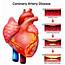 Global Coronary Artery Disease Treatment Devices Market Research Report 