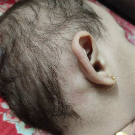 Asktheexpert Hi There Is A Nodesmall Lump Behind My Babys Ear No