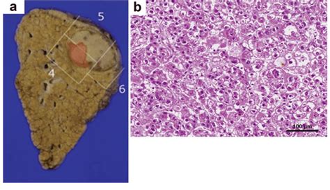 Histopathological Findings Of The Resected Liver A Photograph