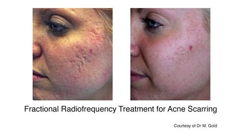 Acne Treatment Acne Scar Scarring Removal Cardiff London United