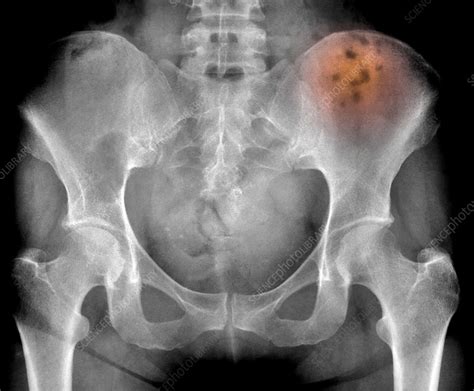 Bone Marrow Cancer X Ray Stock Image C Science Photo Library