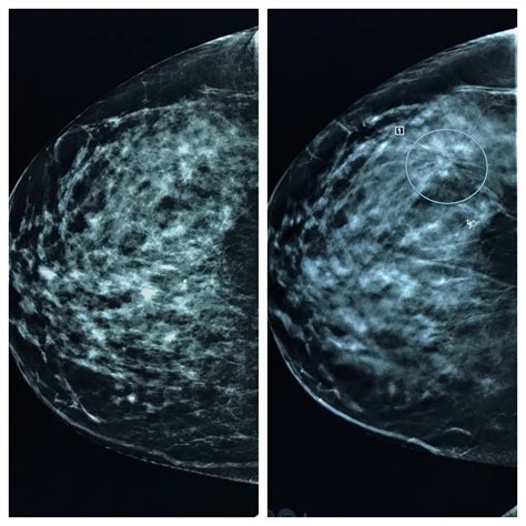 The 3d Mammogram On The Right Shows The Breast Cancer Much Better Than