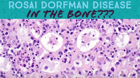 Rosai Dorfman Disease In The Bone Bone Tumor Pathology