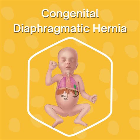Understanding Congenital Diaphragmatic Hernia Dr Geeta Kekre