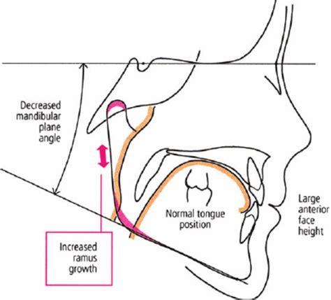Tracing Of A Child After Adenotonsillectomy Because Of Normalization