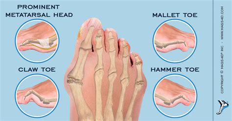 Types Of Foot Deformities Mass4d® Foot Orthotics
