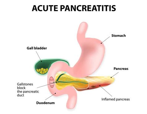 Acute Pancreatitis Causes Symptoms And Treatments Medical News Today