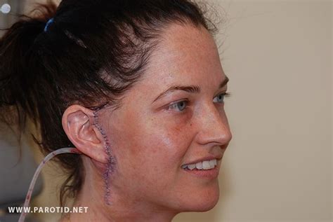 Parotid Tumor Surgery Stories And Pictures From Patients Parotid