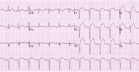 Study Medical Photos Acute Anterior Myocardial Infarction Ecg