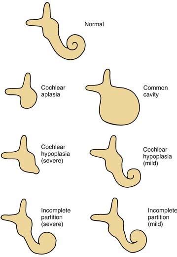 Congenital Malformations Of The Inner Ear Ento Key