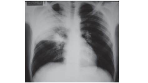Bacterial pneumonia is a type of pneumonia caused by bacterial infection. Consolidação Pulmonar e Atelectasia Conheças as diferenças.