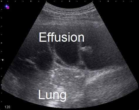 And visible when both pleura are separates by a structure that allows ultrasound transmission; Pleural Space Infections/Empyema - The Clinical Advisor