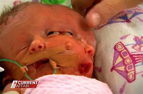 conjoined twins faith and hope die after a miraculous 19 day l daily mail online