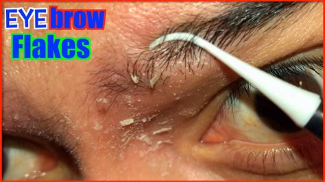 Eyebrow Flake Montage Ep3 Dandruff Flakes Seborrheic Dermatitis