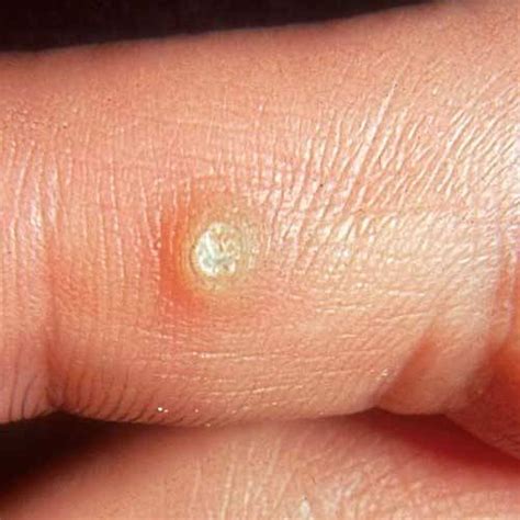 Skin Condition About Warts