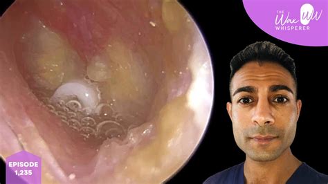 1235 3 Visits For Treating Grommet Middle Ear Infection Youtube