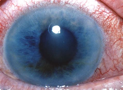 Glaucoma refers to a group of similar conditions that damage the retina and optic nerve and can cause vision loss and blindness. Narrow Angle Glaucoma - Causes, Symptoms, Treatment and ...