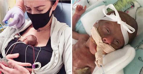 Baby Born At Weeks Defies The Odds To Survive