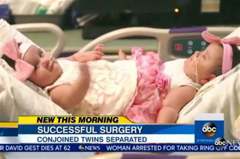 Conjoined Twins Undergo A 12 Hour Separation Surgery