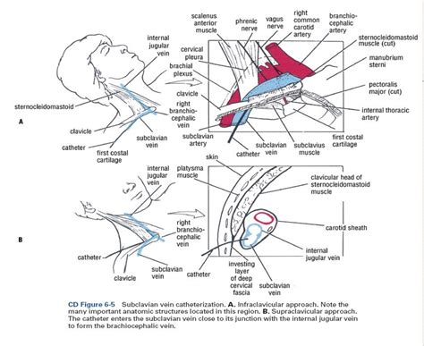 Central Line Internal Jugular Vein Anatomy
