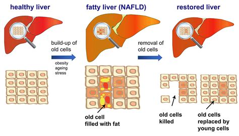 Fatty Liver Disease Reversed Press Office Newcastle University