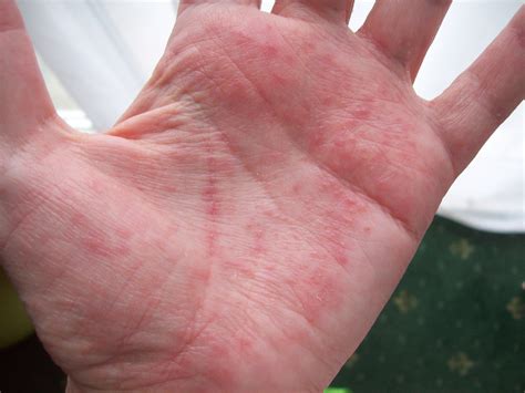 Red Spots On Palm Of Hand Pictures Photos