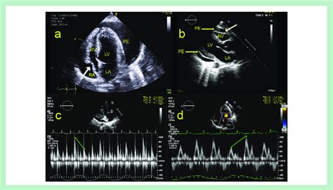 A Apical Four Chamber View Tte Showing A Large Pericardial Effusion