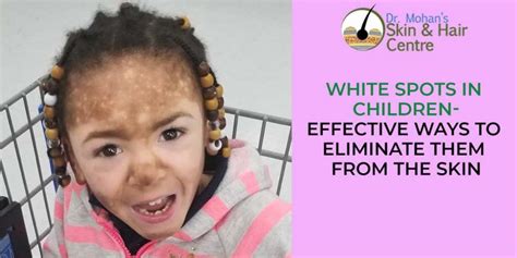 White Spots In Children Effective Ways To Eliminate Them From The Skin