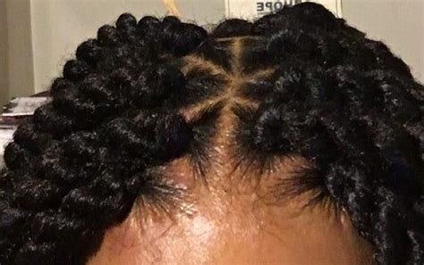 Effects Of Tight Braids What To Do When Your Braids Are Too Tight