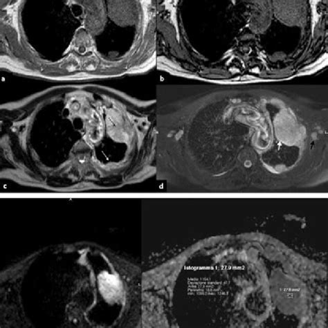 Malignant Pleural Mesothelioma Axial T1 Weighted Mr Images Showing A