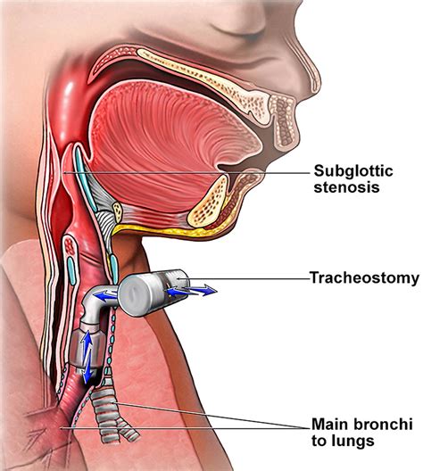 Anatomy Of The Trachea With Proper Tracheostomy Placement Sexiezpix