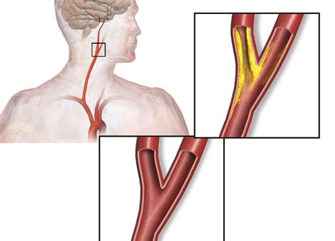 Carotid Artery Stenosis Ultrasound Diagnosis SIFSOF
