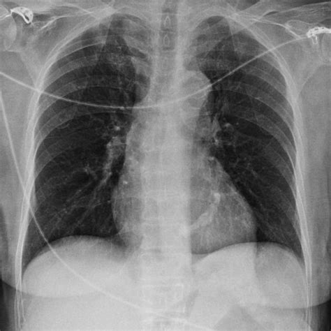 Mitral Annular Calcification Radiology Case